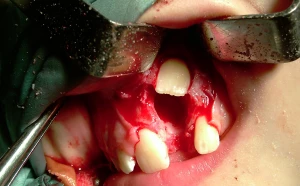 Zębiak - guz zębopochodny