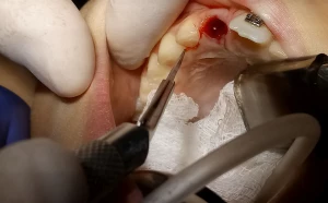Leczenie ortodontyczno-chirurgiczne - operacyjne odsłonięcie zęba zatrzymanego z wprowadzeniem zęba do łuku
