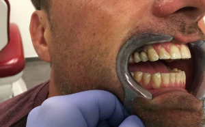 Simplant – Immediate Smile- nawigowane komputerowo leczenie implantologiczne/natychmiastowe uzupelnienie