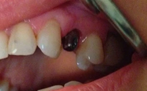 Uzupełnianie pojedynczego braku zęba implantem