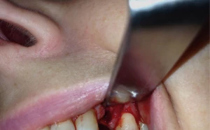 Uzupełnianie pojedynczego braku zęba implantem