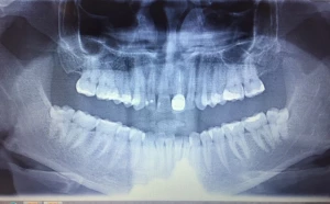  Wykorzystanie usuniętego zęba mądrości 48 jako autogennego materiału do odbudowy kości po zabiegu resekcji